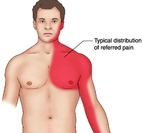 ملف:Distribution of referred pain.jpg