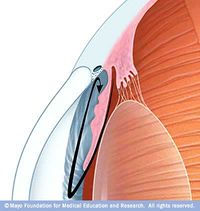 Open-angle glaucoma.jpg