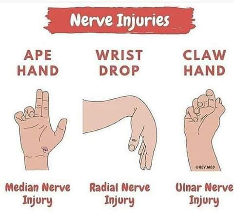 ملف:Nerve injuries.jpg