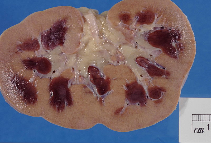 ملف:Kidney acute necrosis.jpg