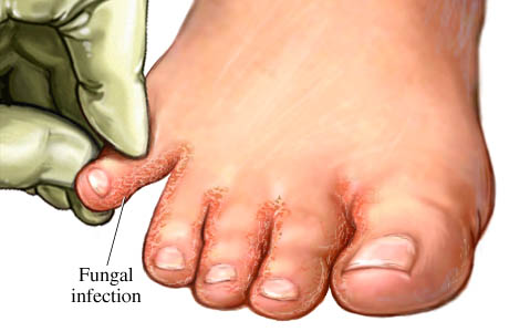 ملف:Athletes-foot.jpg
