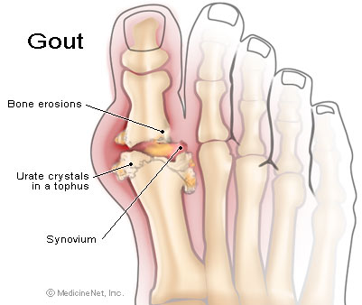 ملف:Gout.jpg