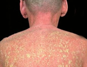 ملف:Seborrheic dermatitis.jpg