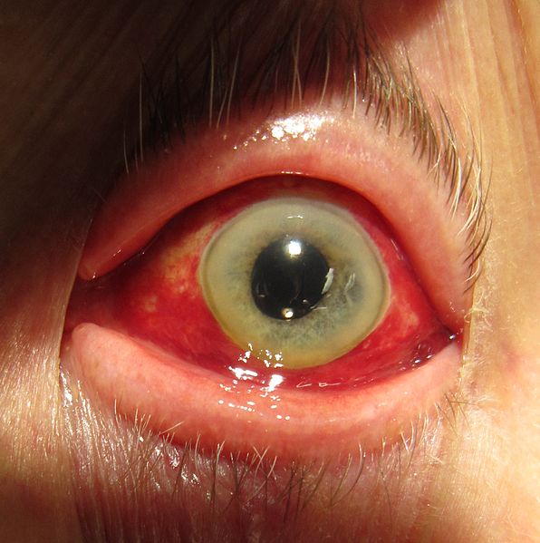 ملف:Human eye showing subconjunctival hemorrhage.jpg