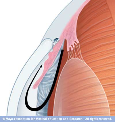 ملف:Angle-closure glaucoma.jpg