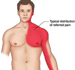 Distribution of referred pain.jpg