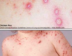 Chicken pox.jpg