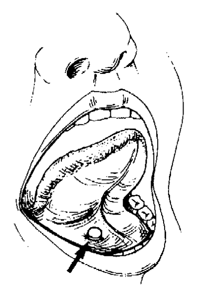 ملف:Subligual tablet.gif