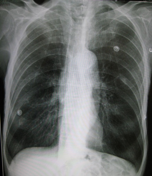 ملف:Emphysema2008.jpg